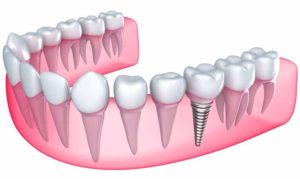 Reidsville Dental Implants